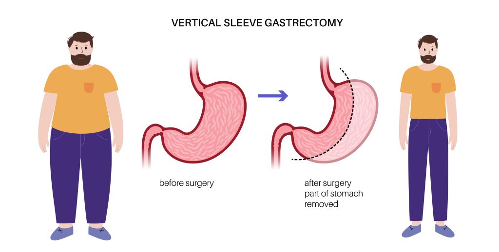 The Vertical Sleeve Gastrectomy