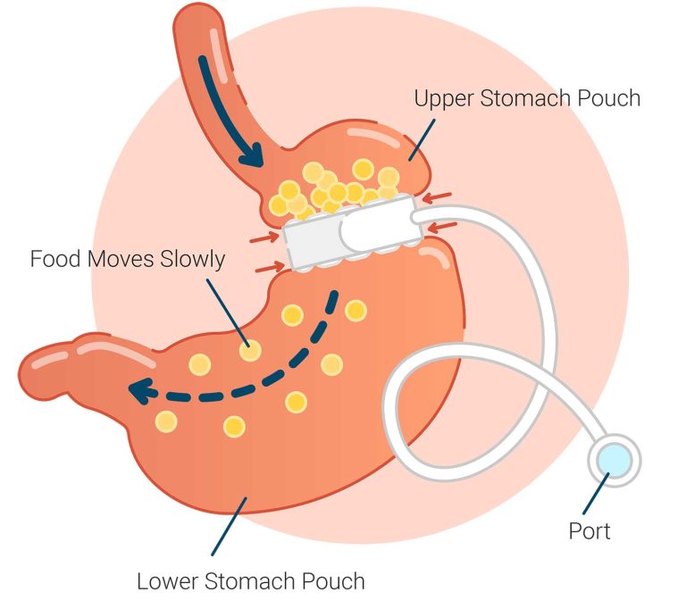 Gastric Band Surgery?