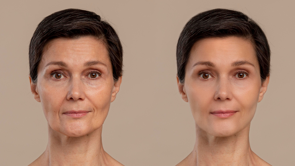 What is Facial Fat Transfer?