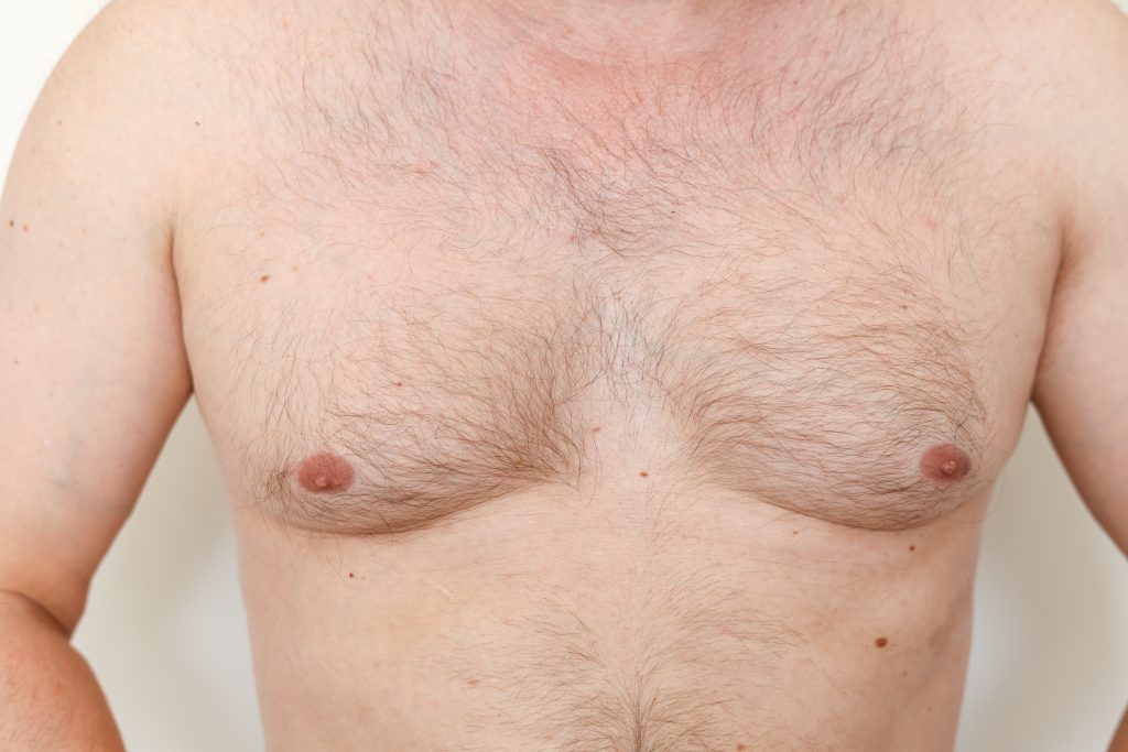 Gynecomastia surgery