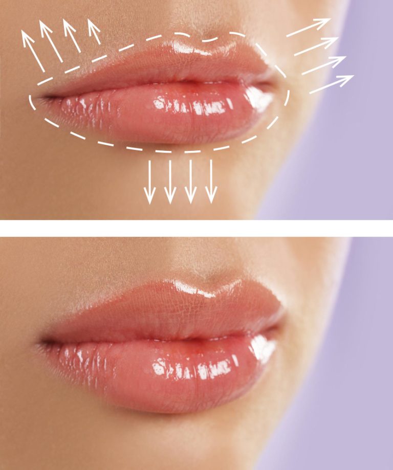 Lip flip: What it is, Benefits, Procedure, results. 