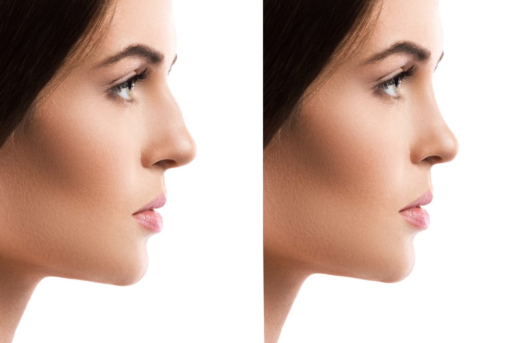 Nose Filler (Rhinoplasty)