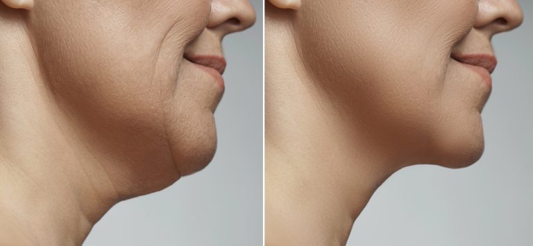 Neck liposuction