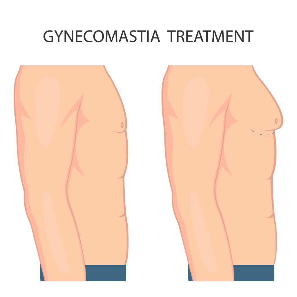 Gynecomastia surgery