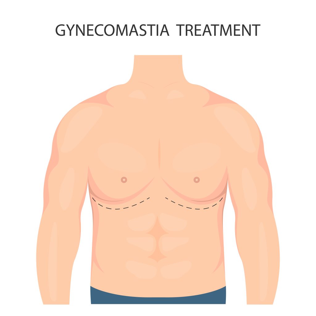 Gynecomastia surgery