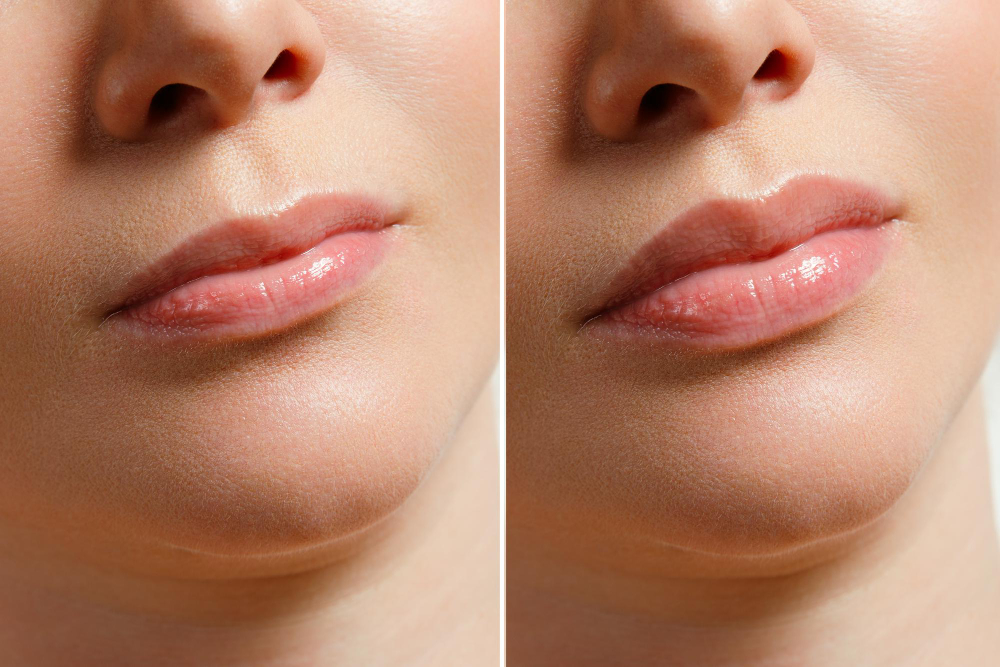 Lip flip: What it is, Benefits, Procedure, results. 