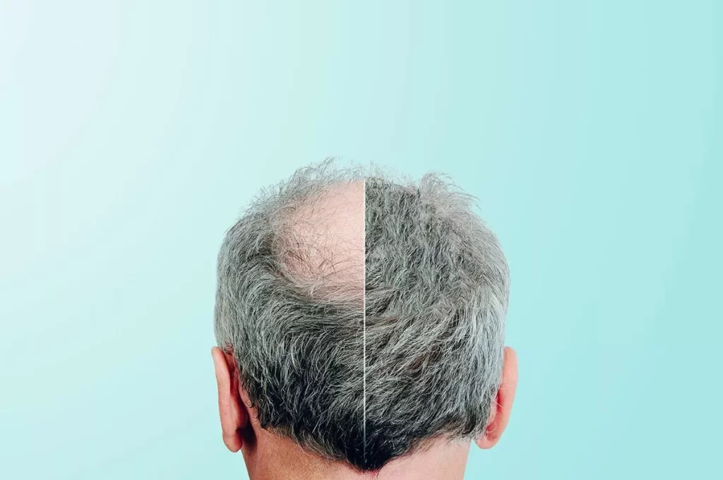 What is a FUE hair transplant?