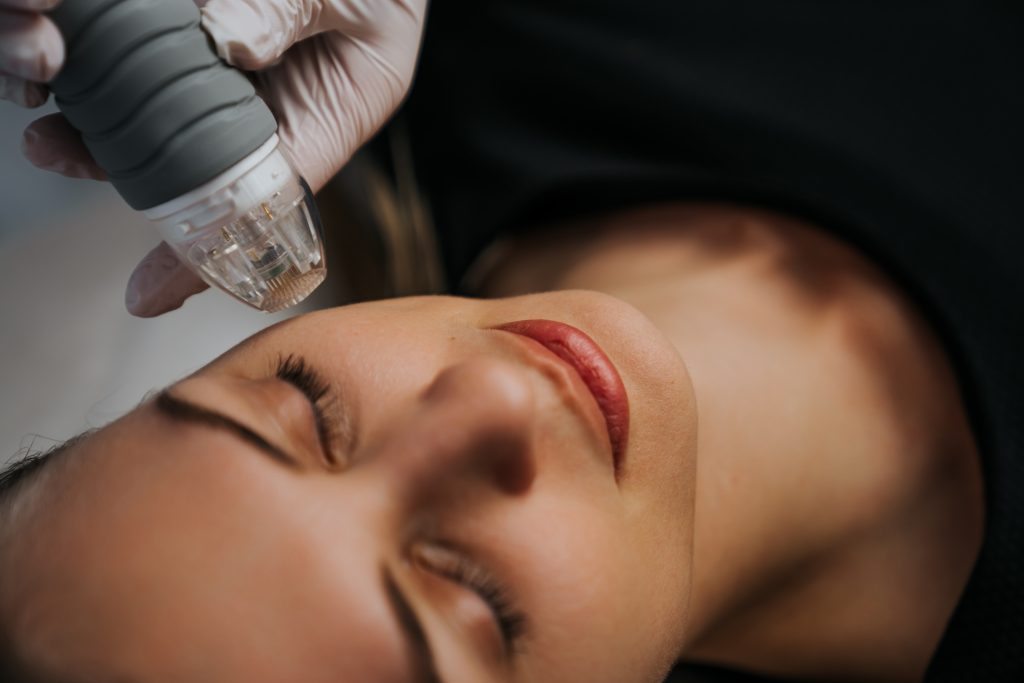 Radiofrequency Microneedling