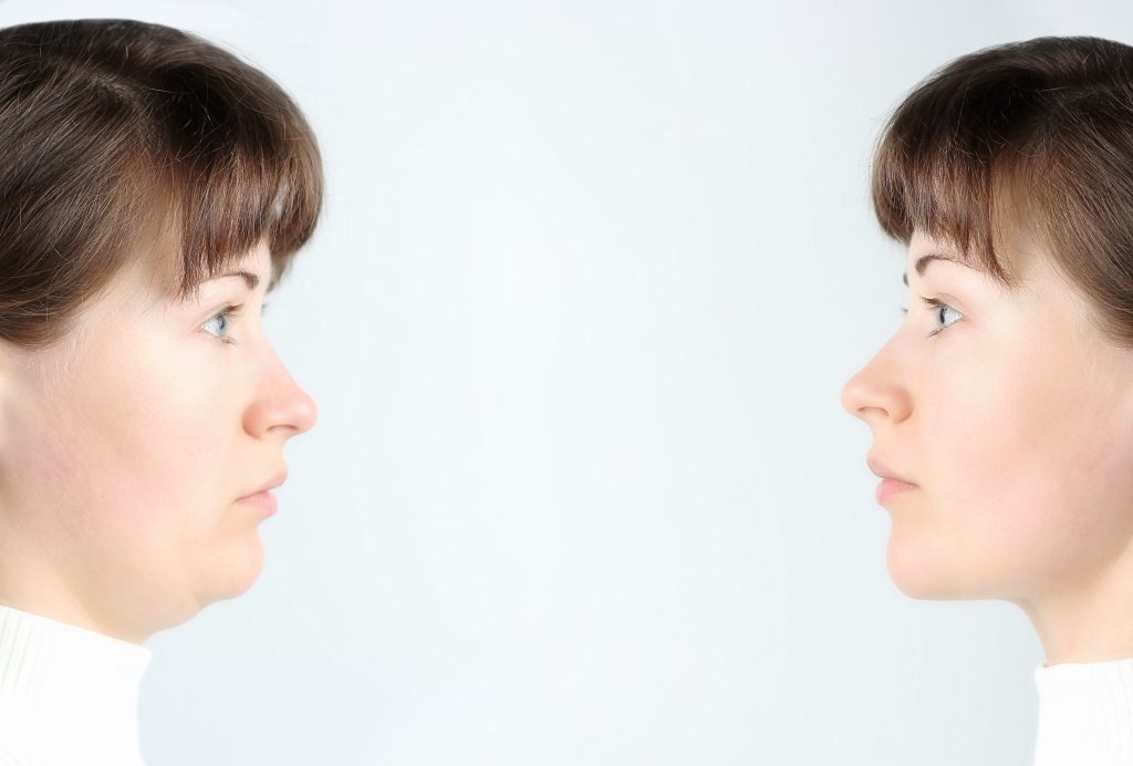 Double Chin Surgery? Don't Panic: A Guide to Exploring Surgical and Non-Surgical Solutions