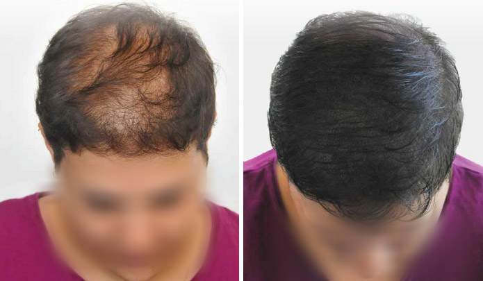 زراعة الشعر للنساء