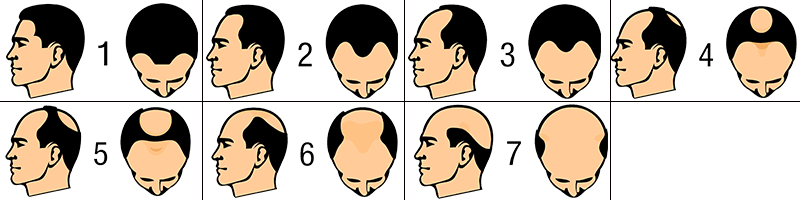 Hair loss in men patterns