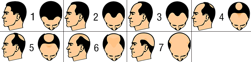 أنماط تساقط الشعر عند الرجال