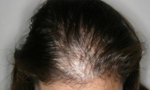 Hair loss in women