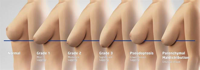 What is Breast Sagging? - Turkey Istanbul Medical