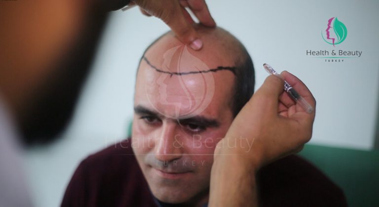Beard Transplant