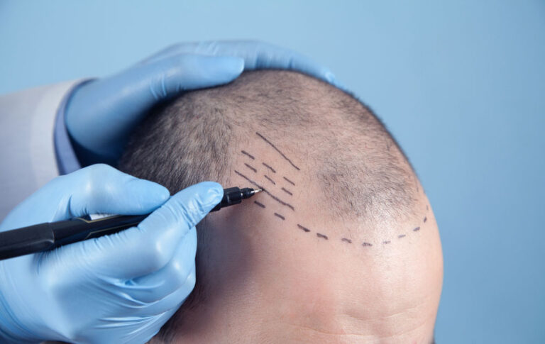 Beard Transplant