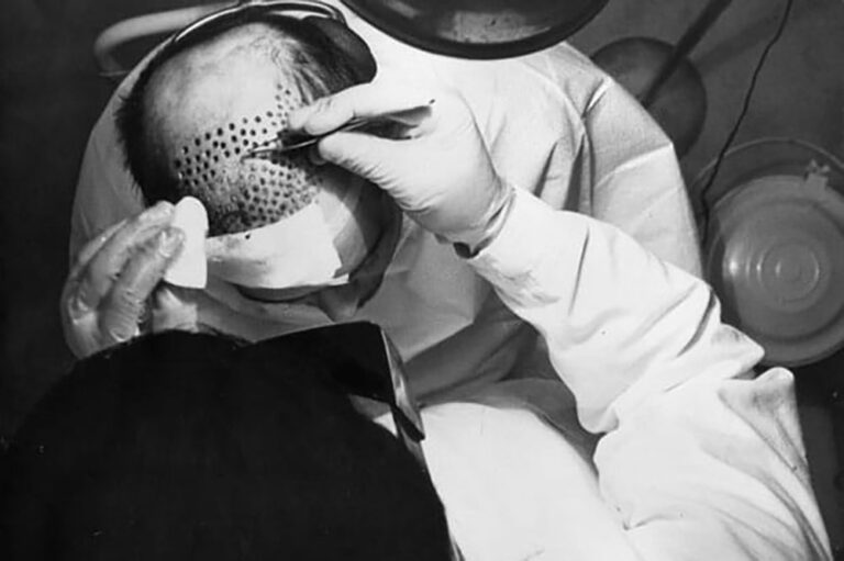 Hair Transplant Procedures