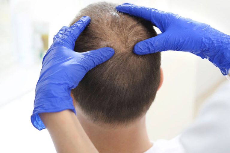 Hair Transplant Procedures