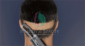 زراعة الشعر بتقنية SAPPHIRE