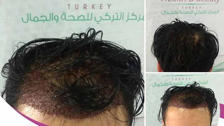 زراعة الشعر بدون حلاقة