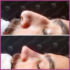 Rhinoplasty