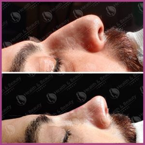 Rhinoplasty