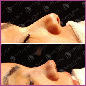 Rhinoplasty