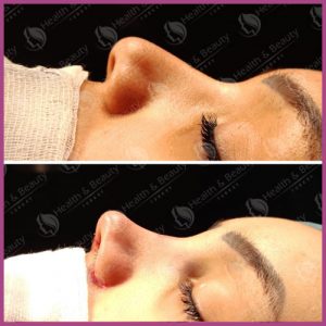 Rhinoplasty