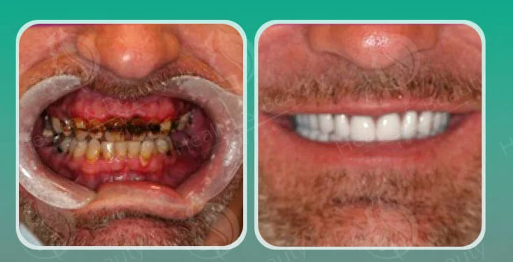 Dental Crown