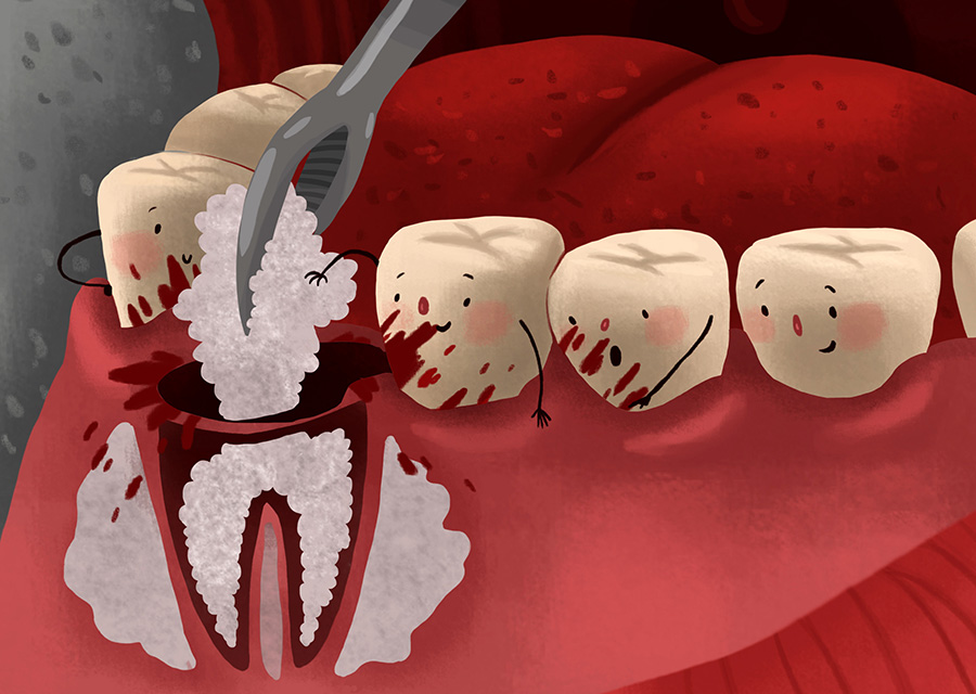 تدعيم عظم الفك لزراعة الأسنان