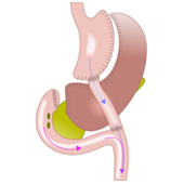 Gastric bypass