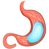 Gastric Balloon