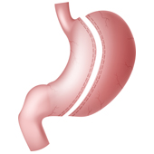 Sleeve Gastrectomy