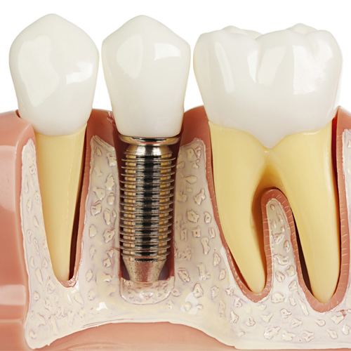 Dental implants in Türkiye