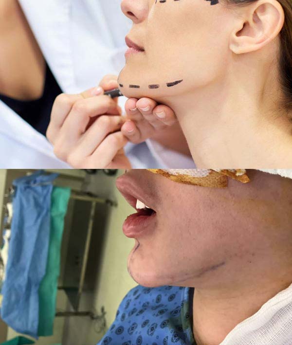 عملية تجميل الذقن