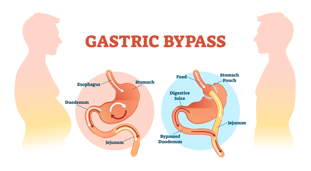 bypass and diabetes