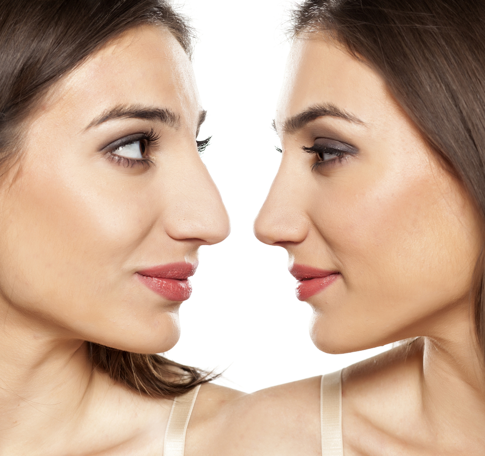 RHINOPLASTY IDEAL CANDIDATE 