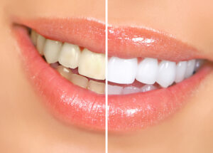 Best store bought teeth whitening kits