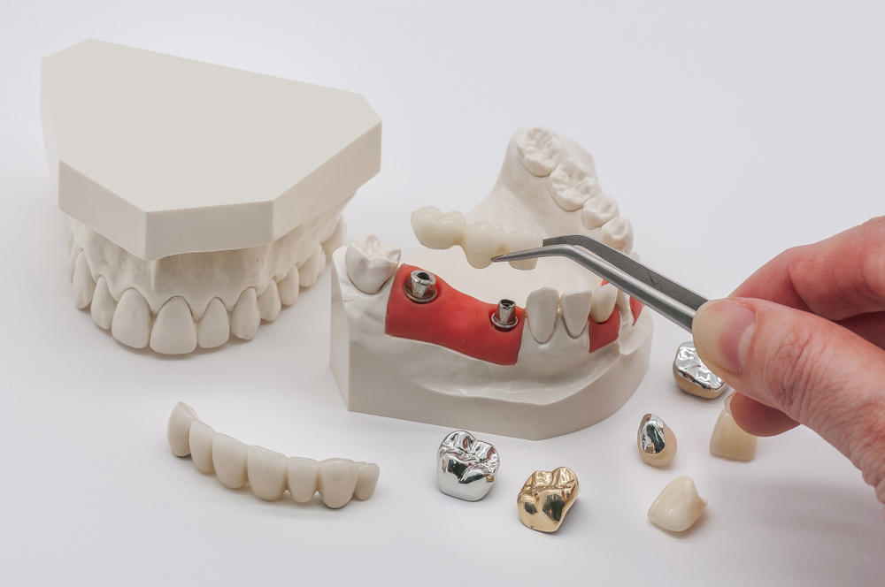 ZIRCONIA DENTAL IMPLANTS