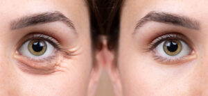 6 طرق غير جراحية لعلاج شيخوخة العين