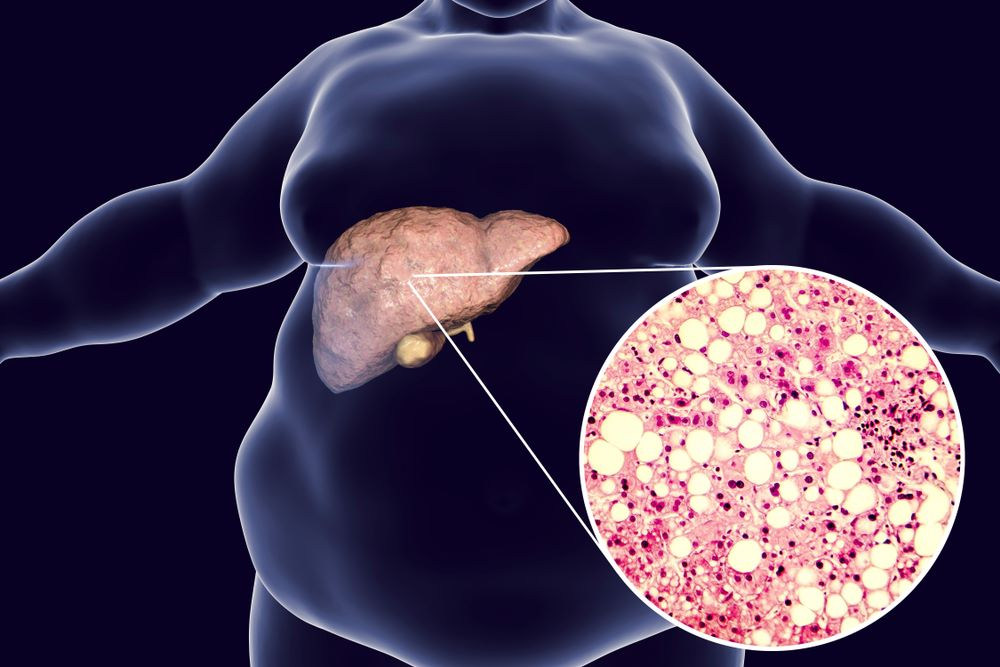 fatty liver and weight loss