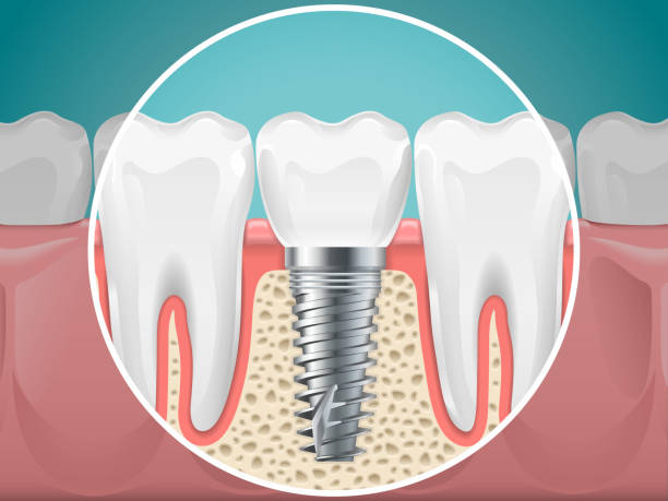 زرعات الأسنان و أنواعها و 5 فوائد لها