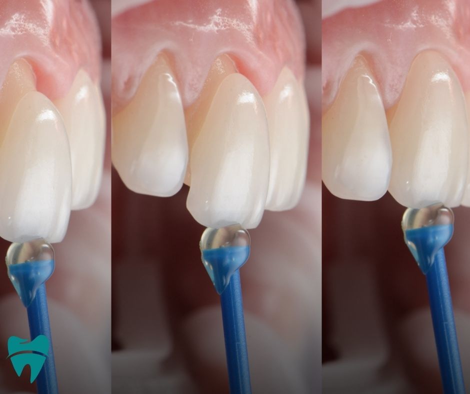 أبرز و أهم 9 علاجات للأسنان في تركيا