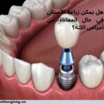 زراعة الأسنان و أمراض اللثة