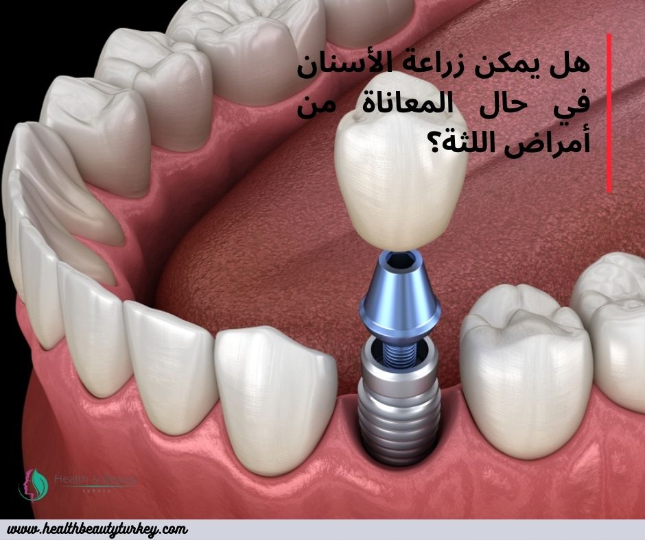 زراعة الأسنان و أمراض اللثة