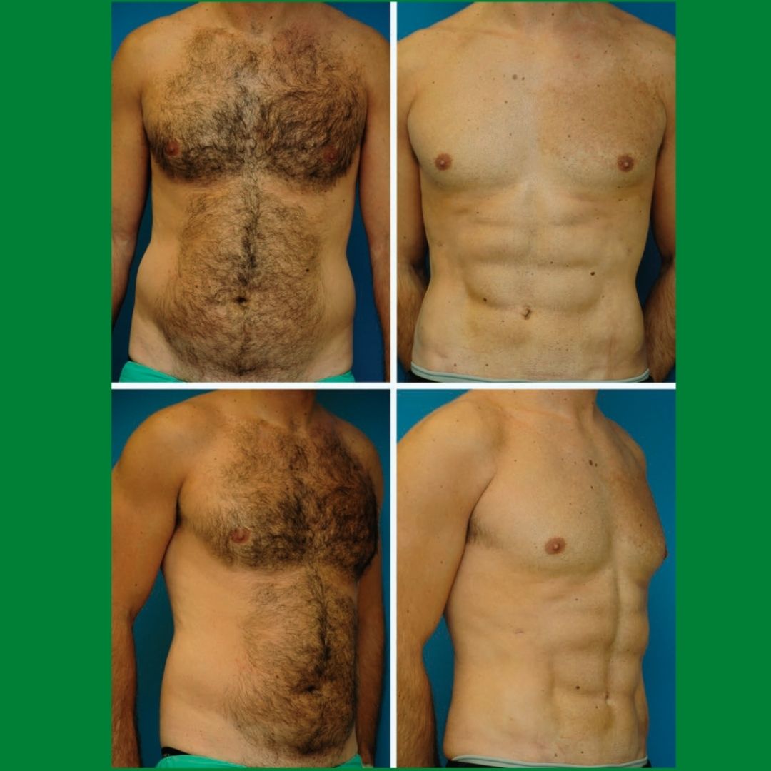 удаления жира с груди у мужчин фото 29