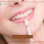 مزايا و مساوئ فينير الأسنان