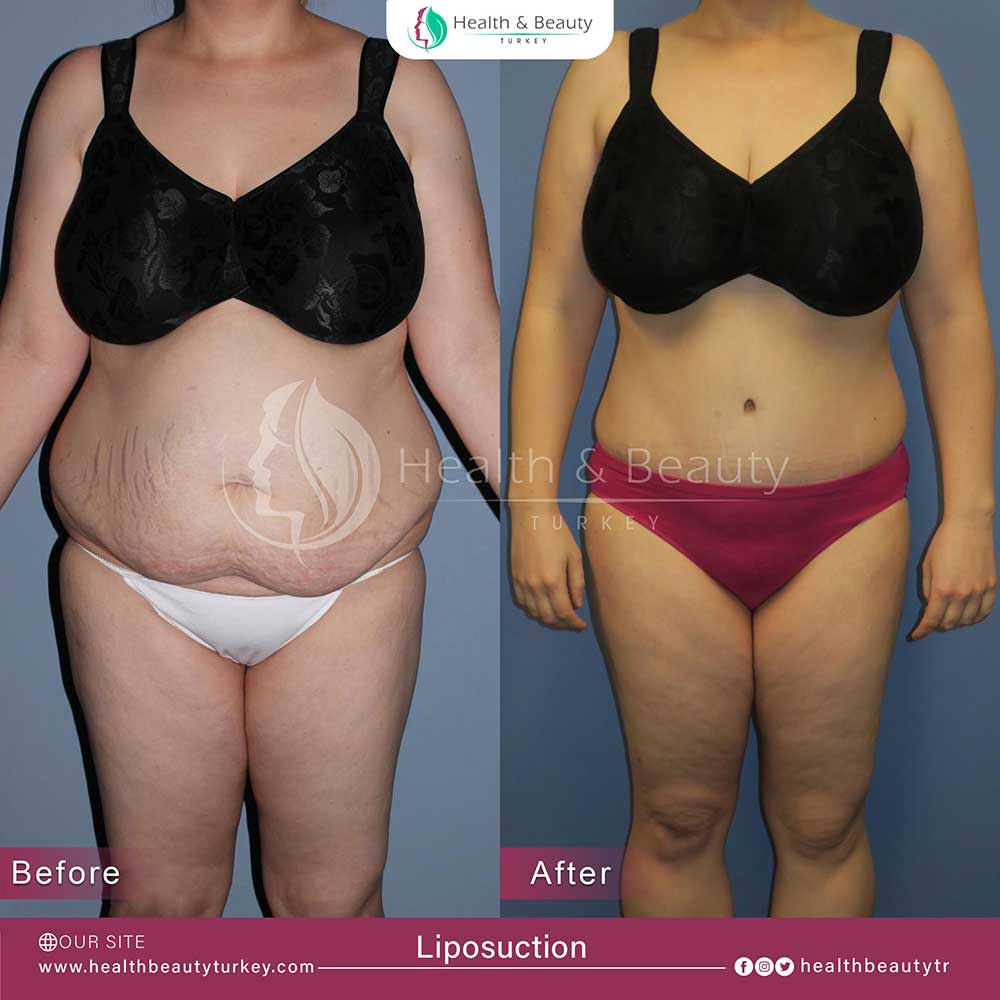 liposuction page fr