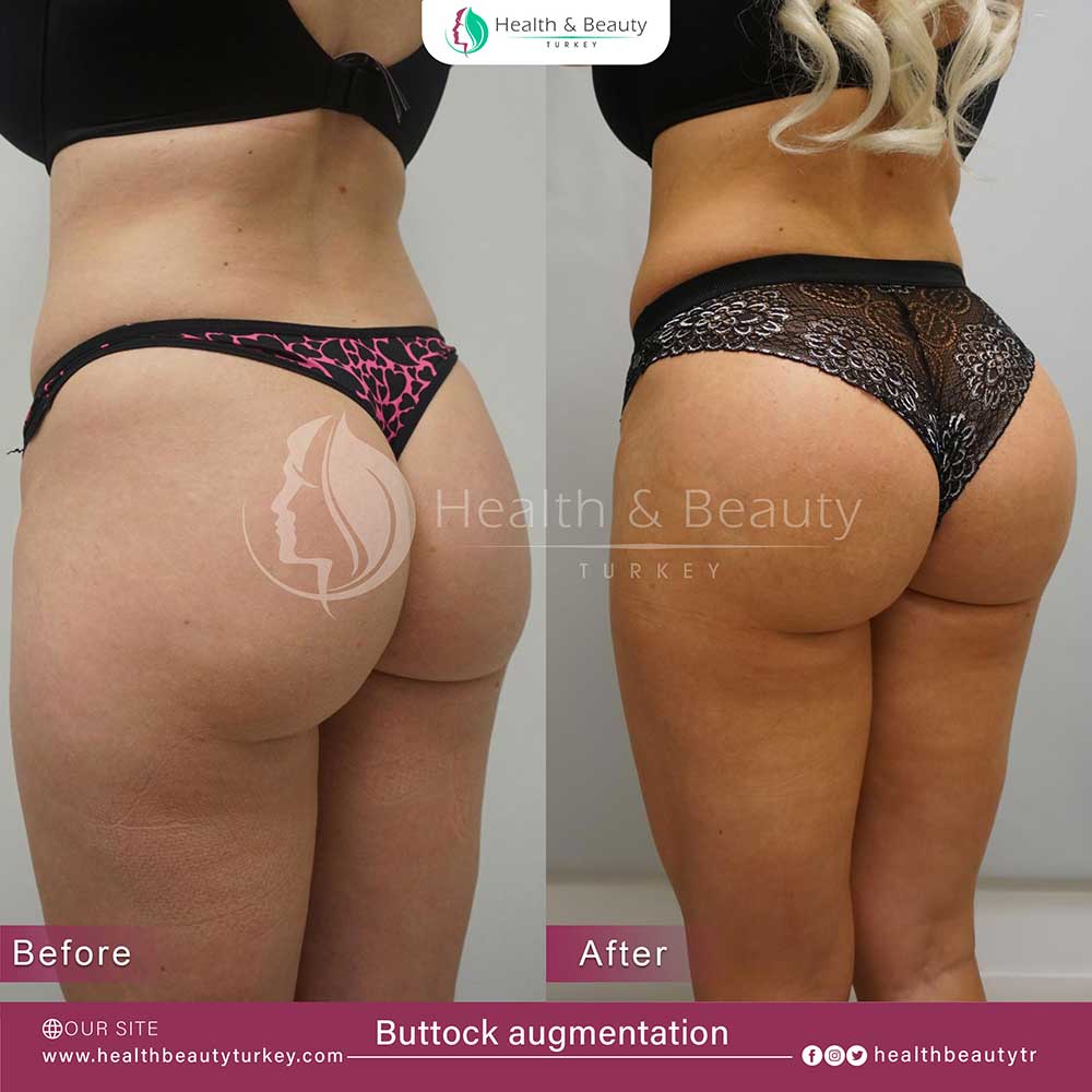 Buttock Augmentation page fr