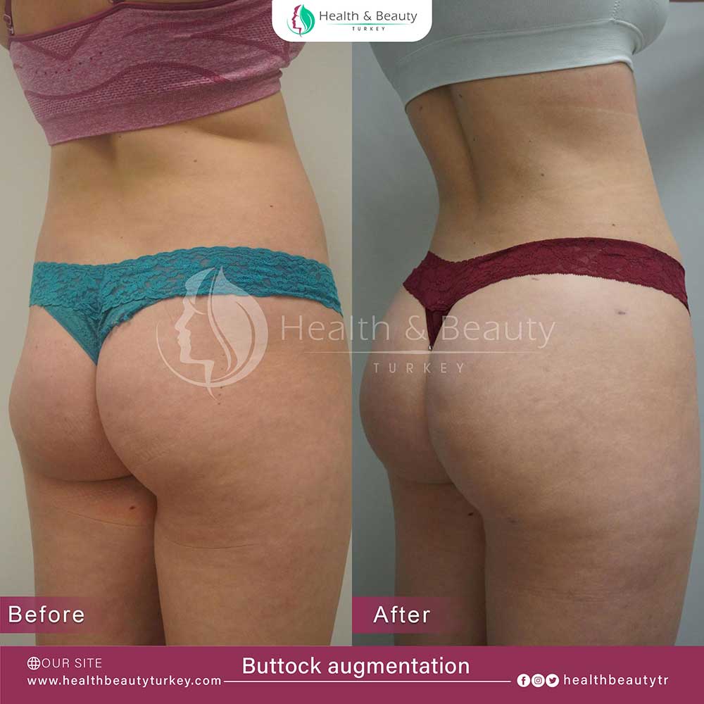 Buttock Augmentation page ar